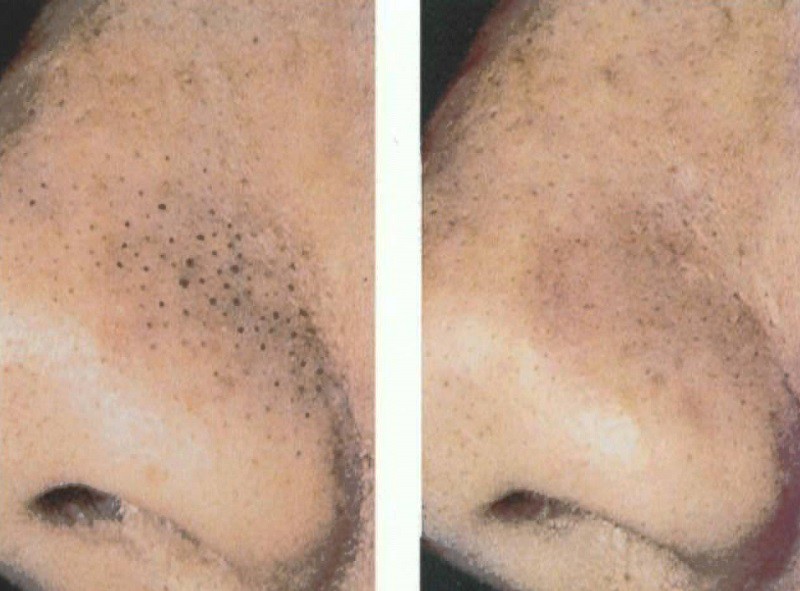 Расширенные поры на лице: решаем проблему – центр косметологии «dетали»