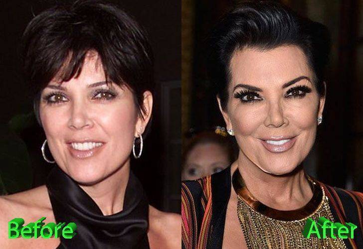 Кайли дженнер: до и после операции (фото) - хирургическое вмешательство в красоту