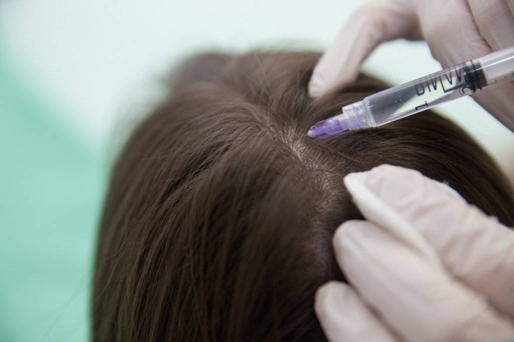 Мезотерапия волос, боремся за здоровье своей шевелюры