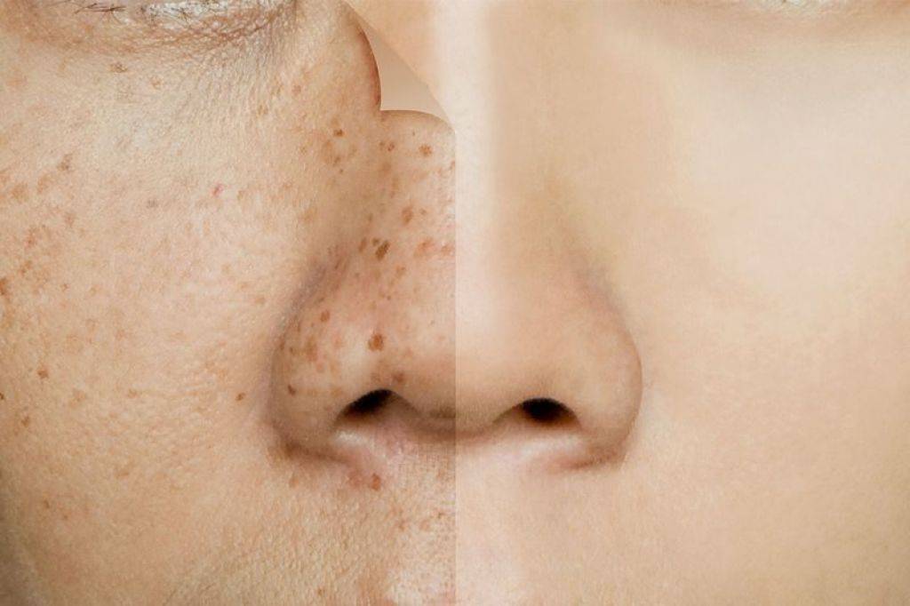 Пигментация кожи: основные причины и способы лечения - клиника "отражение"