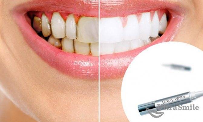 Безопасное отбеливание зубов в стоматологии и дома