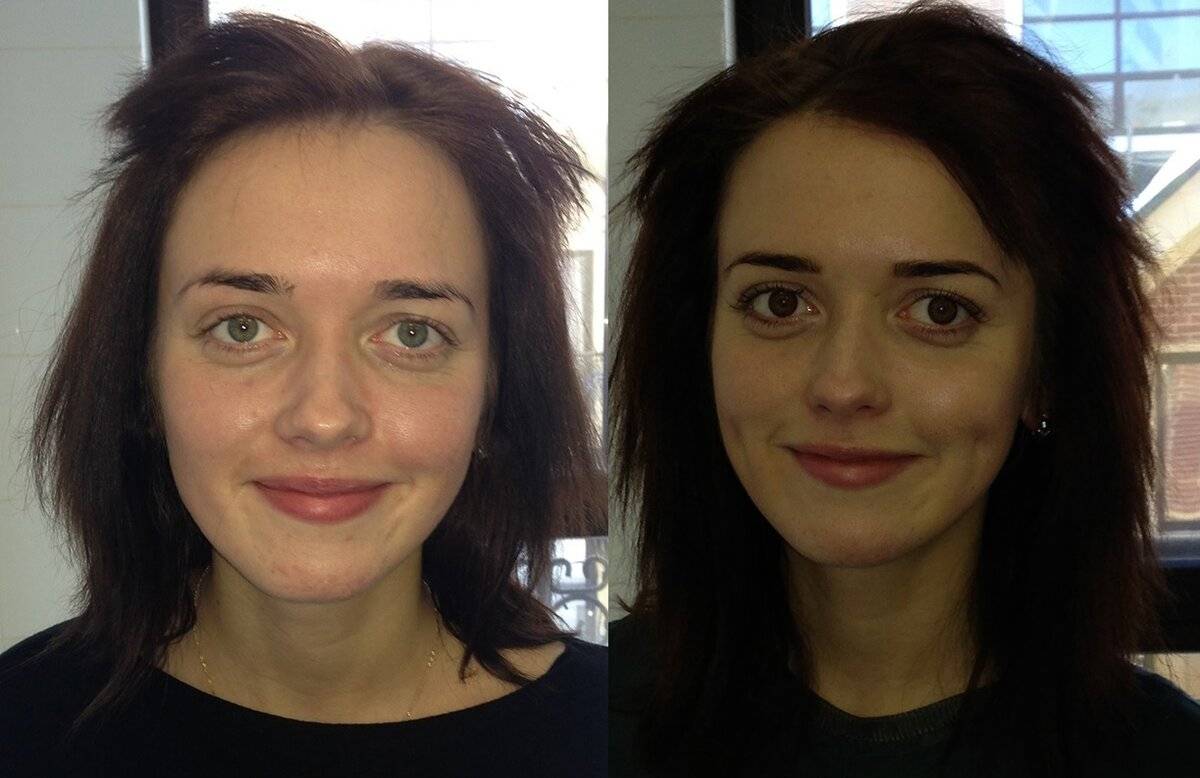 Как брекеты меняют форму лица — фото до и после