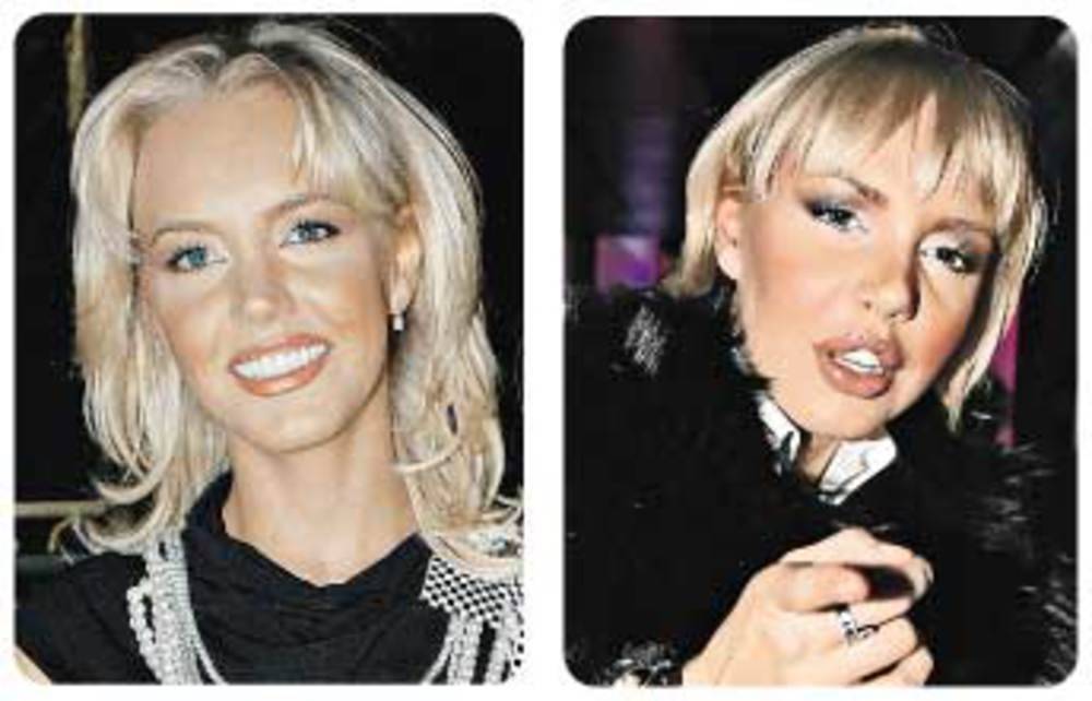 Малиновская маша до и после пластики, неудачная операция, внешность в 2017, почему она стала жертвой