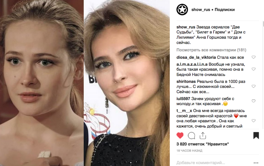 Анна горшкова до и после пластики – фото и все операции знаменитой актрисы