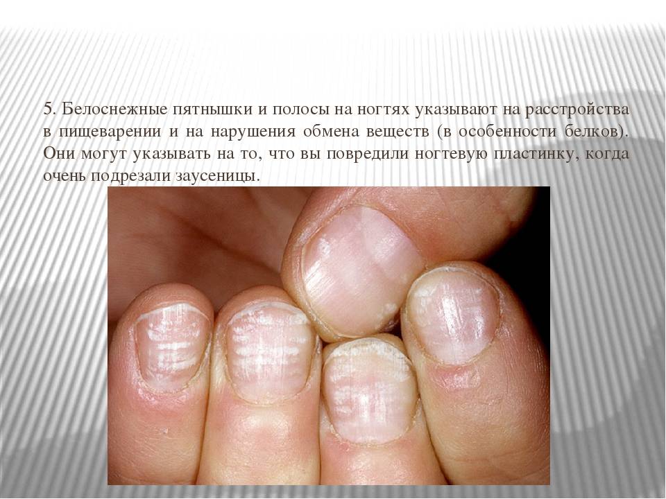 О чем говорит заболевание ногтей. Изменения ногтей заболевания. Заболевания по состоянию ногтей.