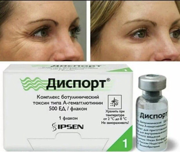 Препарат «диспорт» в объемном моделировании лица