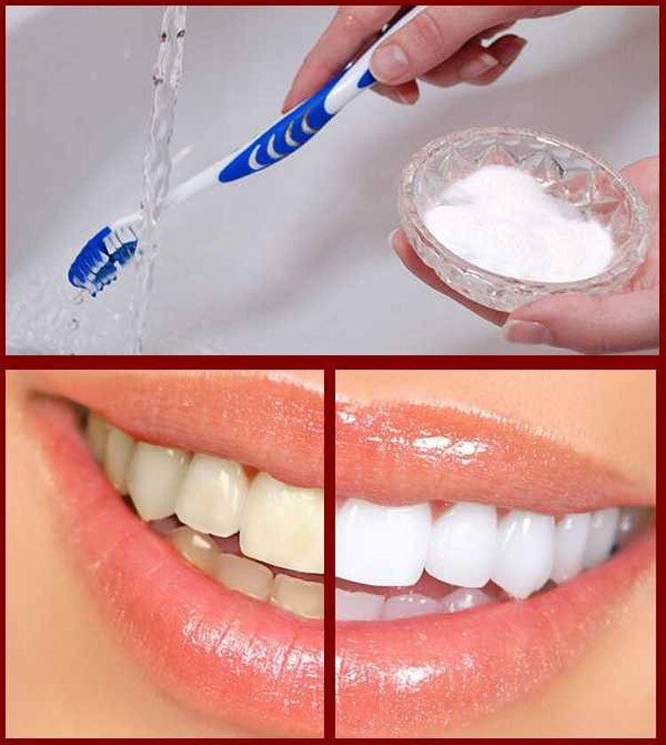 Как безопасно отбелить зубы — стоматология комфорта