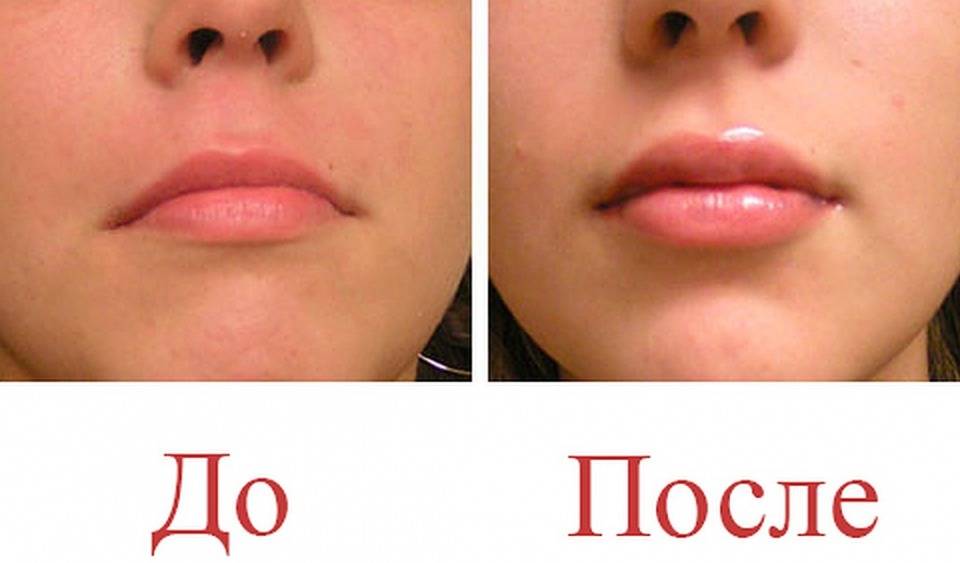 Филлеры для губ – какие из них действительно работают, по мнению косметологов беверли хиллз - клиника косметологии