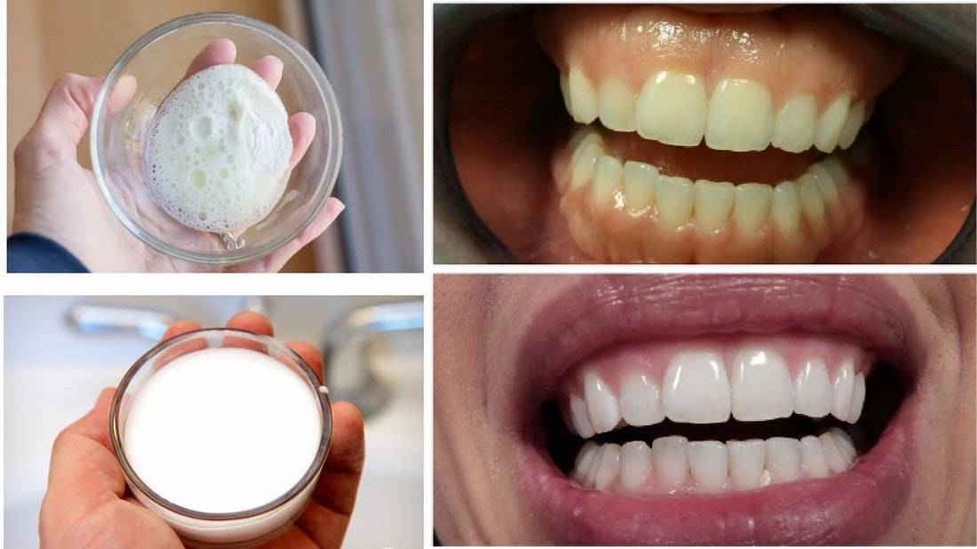 Отбеливание зубов в домашних условиях: самый лучший способ для эмали