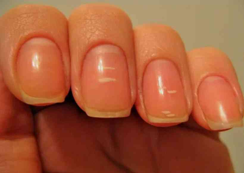 Паронихия - воспаление вокруг ногтя