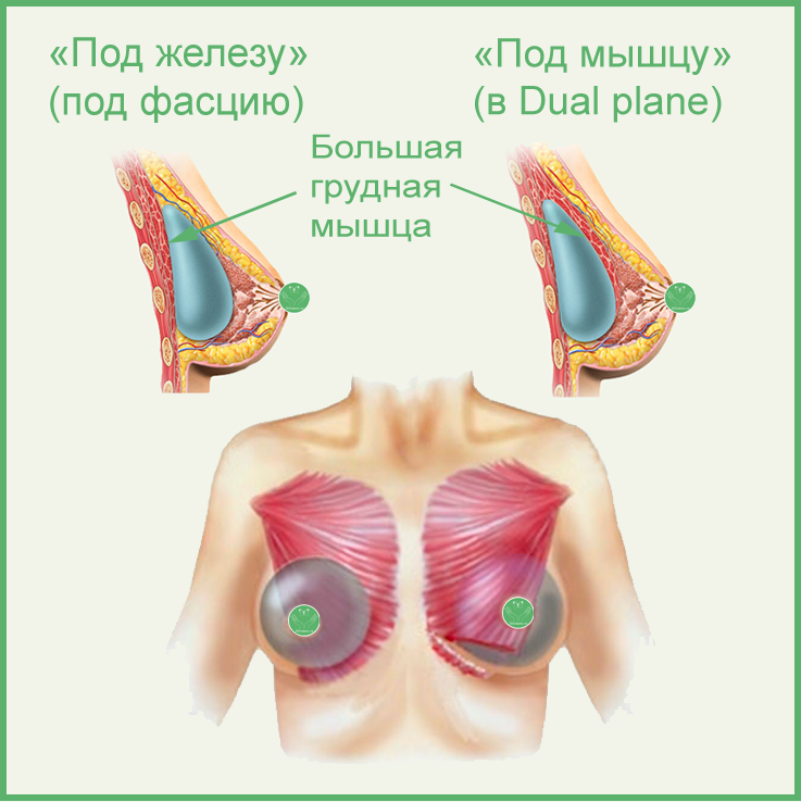 Виды имплантов для увеличения груди