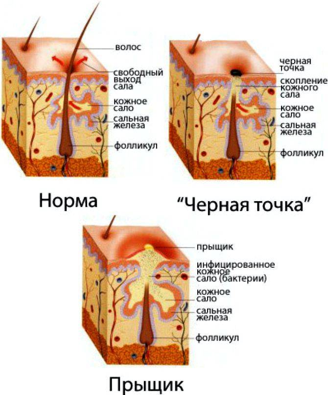 Как избавиться от расширенных пор.  эффективное средство убрать расширенные поры на лице ultraceuticals. лечение расширенных пор лазером