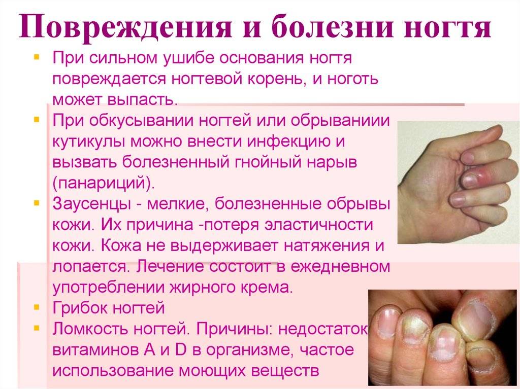 Желтые ногти на руках причины и  доступные способы лечения.