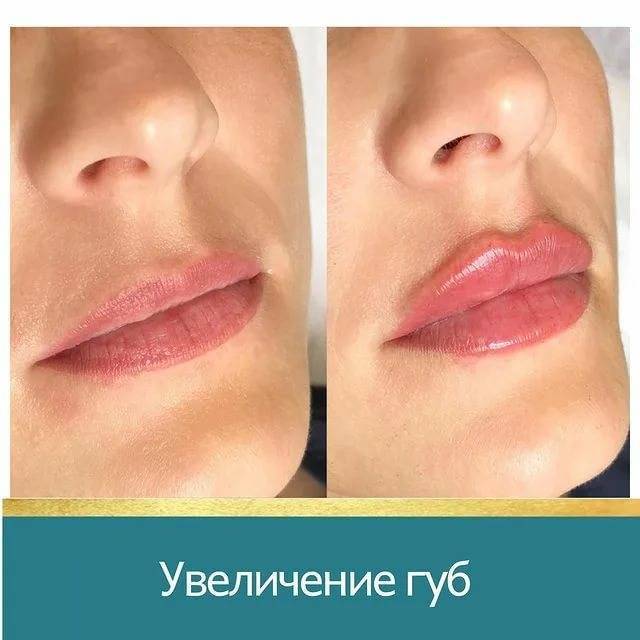 Увеличение и изменение формы губ