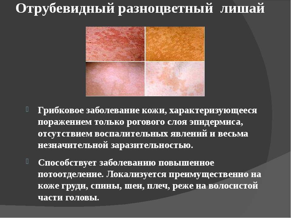 Витилиго