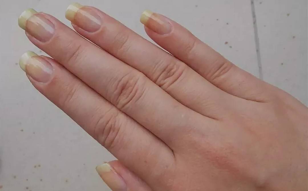 Почему желтеют ногти и как их отбелить