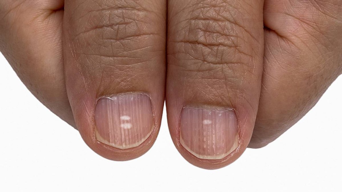 Белые пятна ногтей (бетехтин м.с.) – клиника «семейный доктор».
