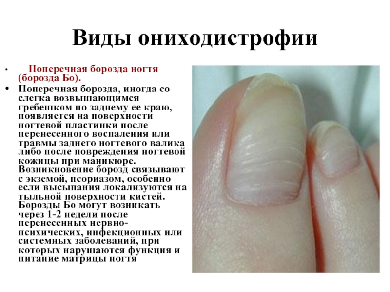 Дистрофия ногтевой пластины на руках и ногах - причины и лечение