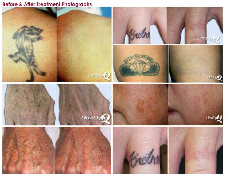 Как удалить татуировку и чем: лазером, способы выведения в домашних условиях, противопоказания