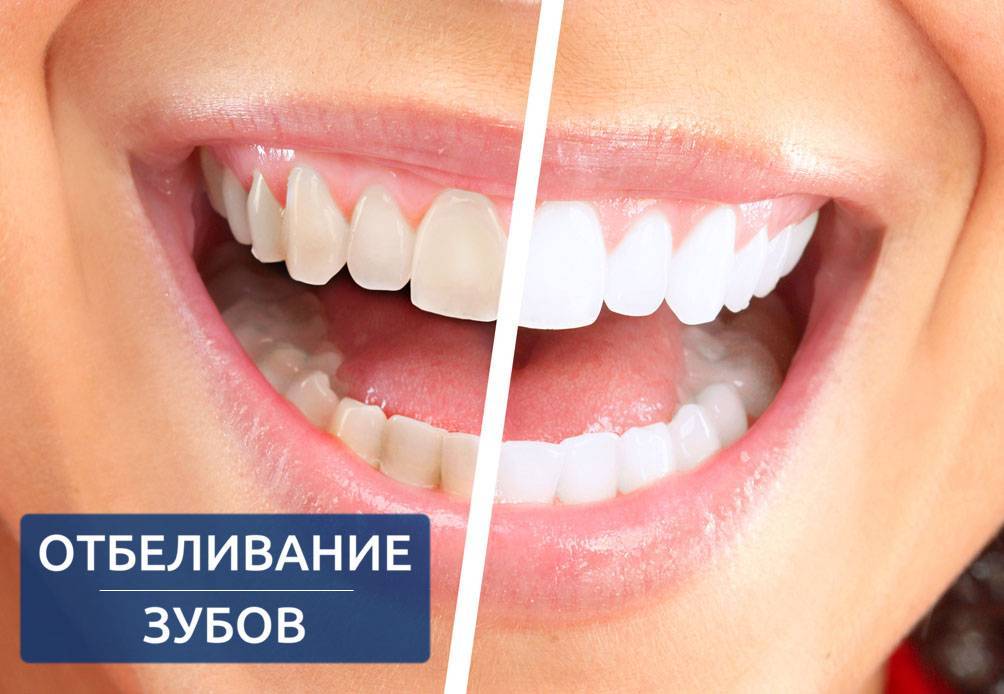 Лучший способ чистки зубов от камня - блог денталюкс