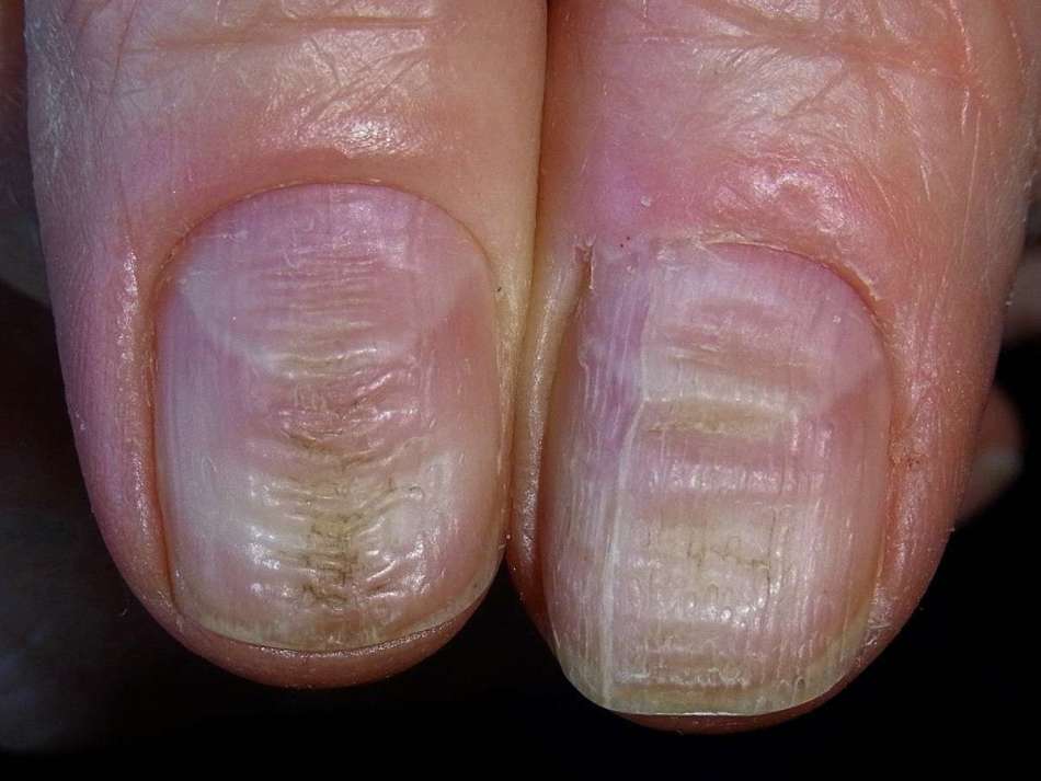 Ребристые ногти на руках: причины и лечение деформации и вмятин ногтей