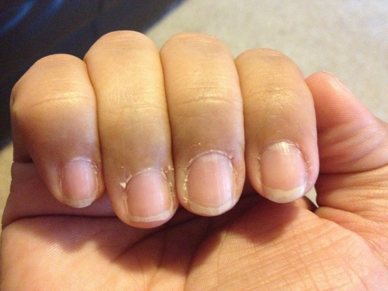 6 способов убрать заусенцы на ногтях