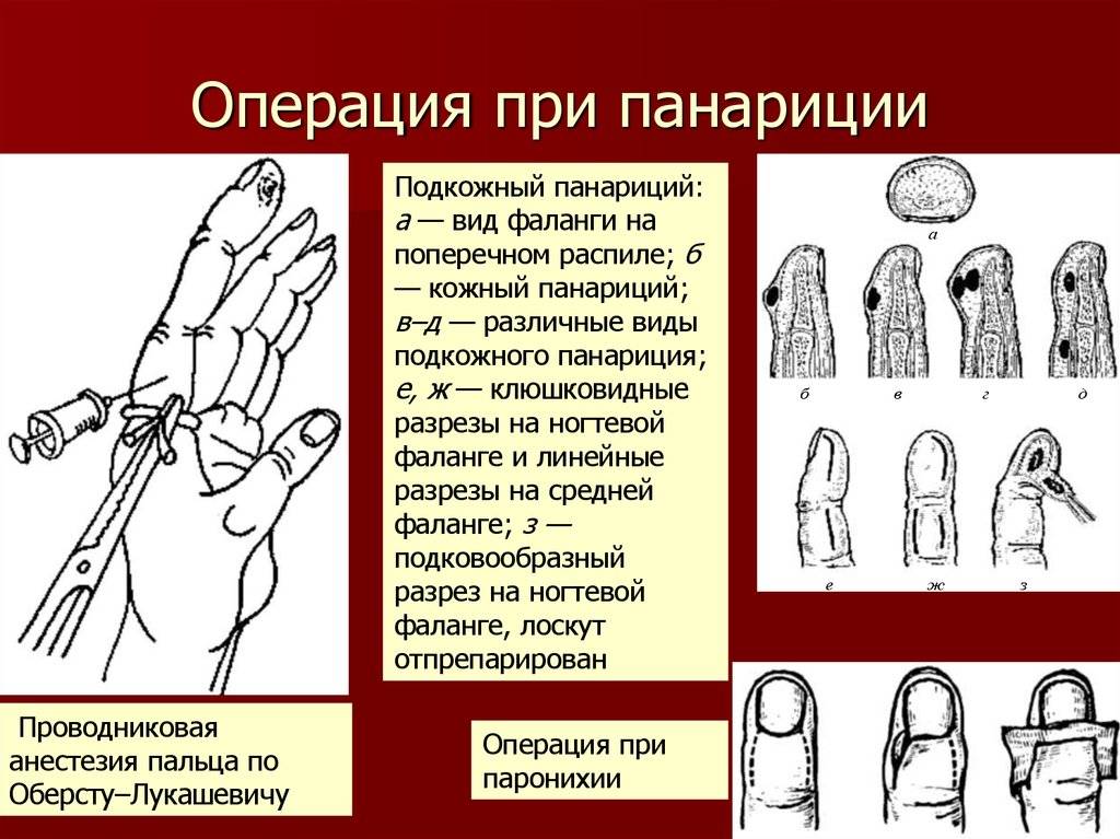 Панариций — причины и лечение воспаления тканей пальца