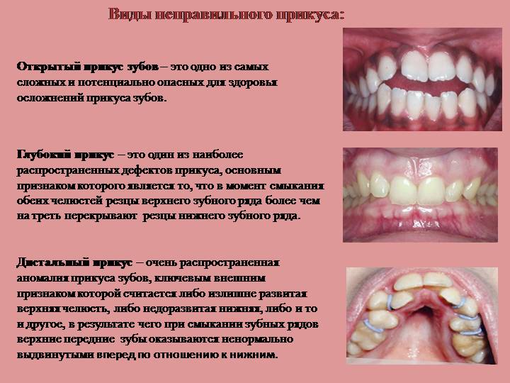 Неправильный прикус зубов у человека