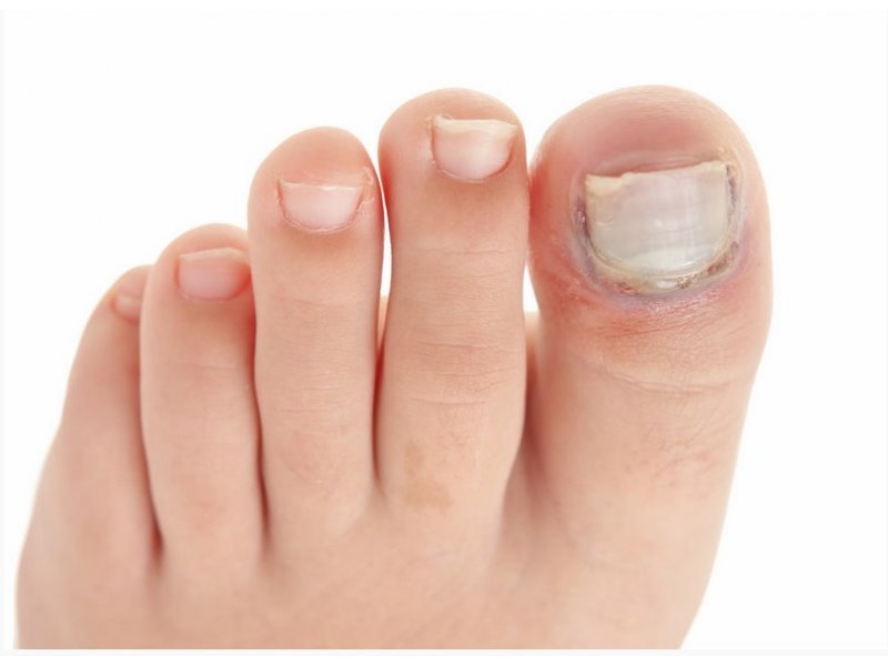 Ушиб ногтя на ноге или руке. что делать, если ребенок прищемил ноготь дверью или ушиб: первая помощь, лечение
