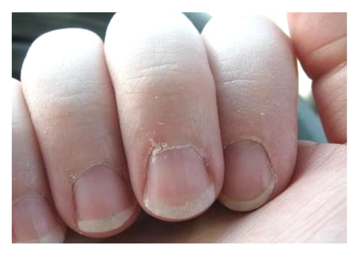Заусенцы на пальцах: причины и лечение, фото