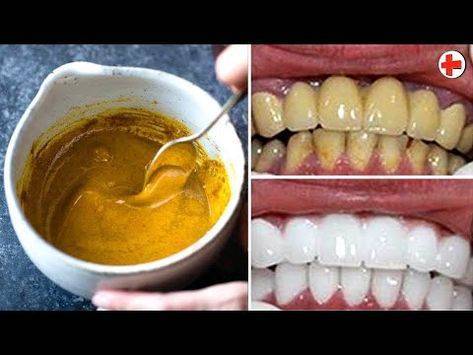 Выбор способа отбеливания зубов