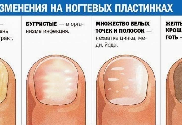 Ногти: основные заболевания * клиника диана в санкт-петербурге