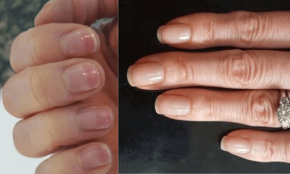 Как восстановить ногти после травмы быстрее всего