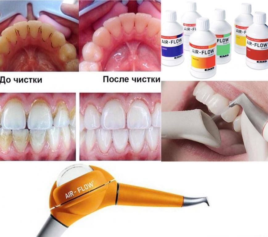 Чистка зубов от зубного камня | удаление камня ультразвуком