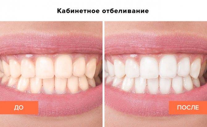 Чем чистка зубов отличается от отбеливания, что лучше выбрать?