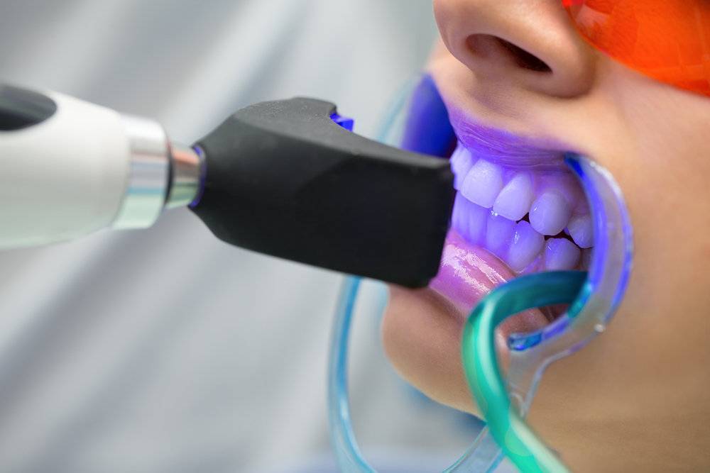 Отбеливание зубов — вредно или нет?