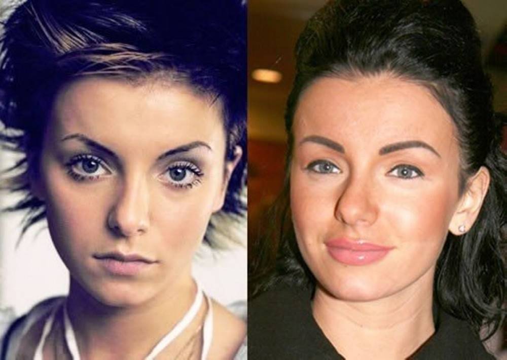 Юлия волкова до и после пластических операции, фото и видео » womanmirror