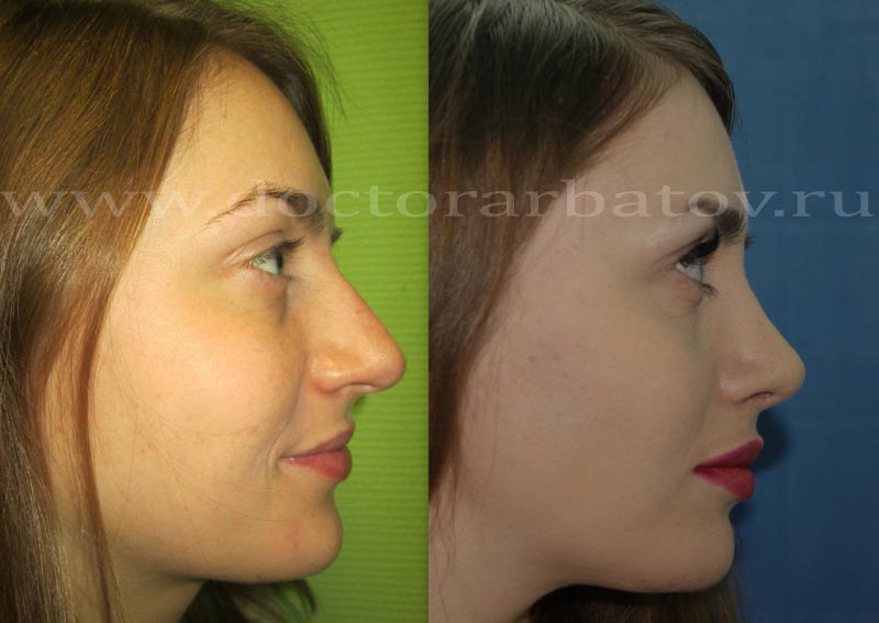 Фото ринопластики до и после нос. Ринопластика горбинки носа. Ринопластика бульбообразного носа. Ринопластика кончика носа до и после. Нос до и после ринопластики.