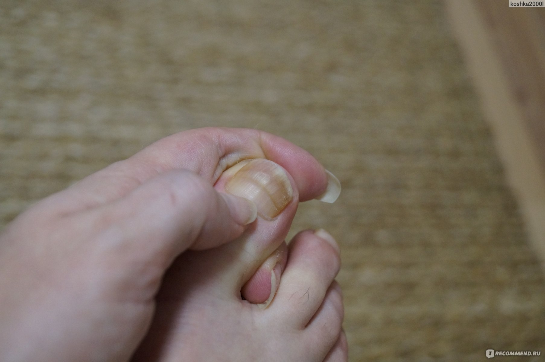 Ушиб ногтя: как и что делать, если на ноге, руке, почернел после травмы, отбитый, с сильным ушибом посинел