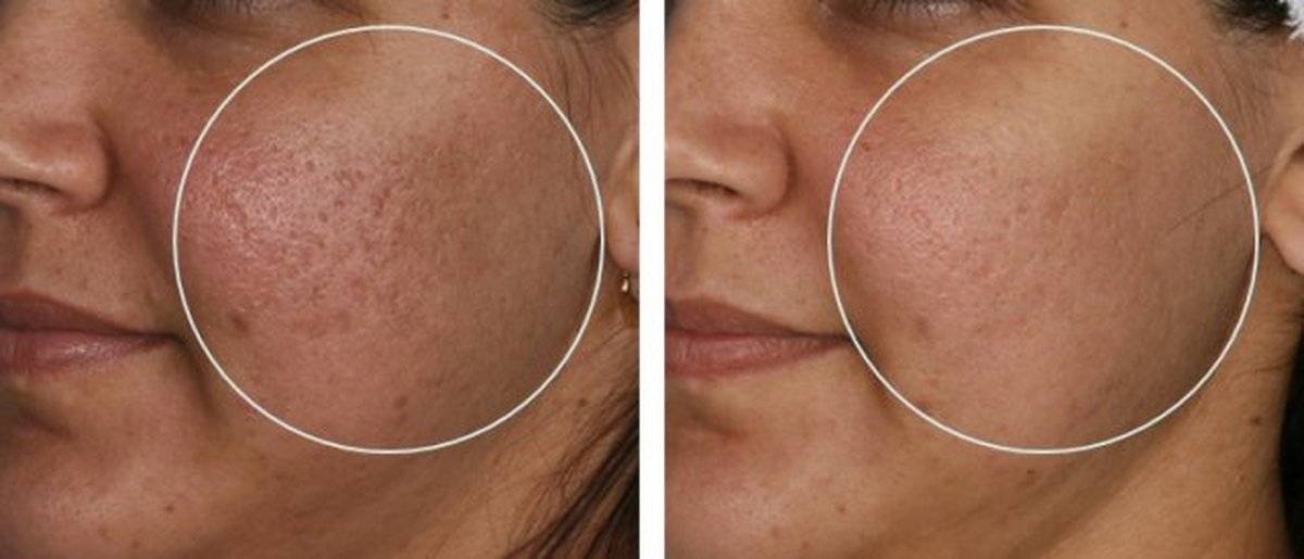 Фотоомоложение кожи лица: плюсы и минусы процедуры