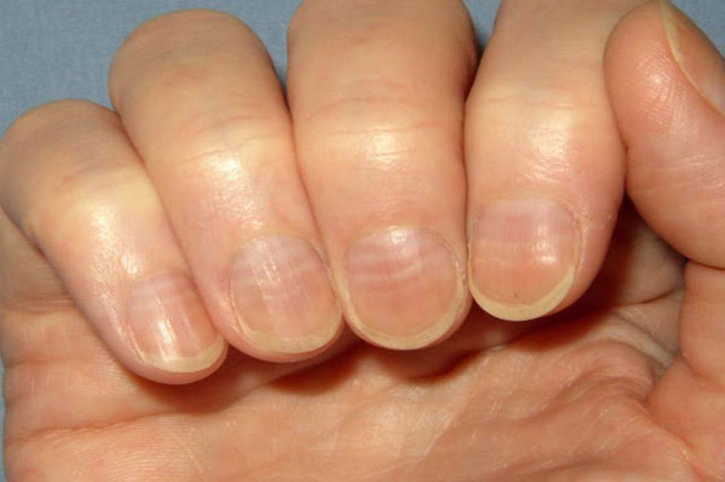 Волнистые ногти на руках - основные причины