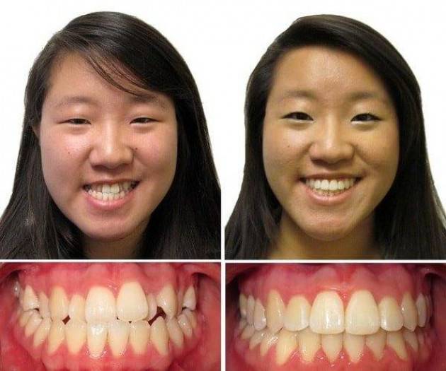 Влияние неправильного прикуса зубов на внешность