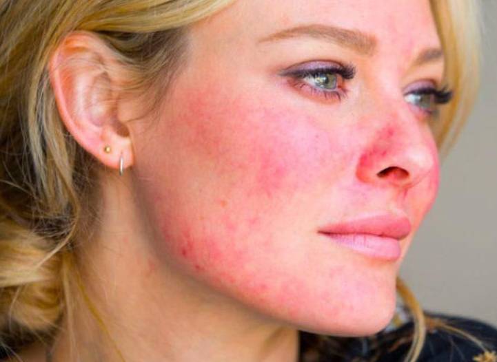 Розацеа на лице: лечение, причины, уход за кожей, как от нее избавиться и чем лечить в домашних условиях - как убрать красноту и какие есть эффективные средства для женщин