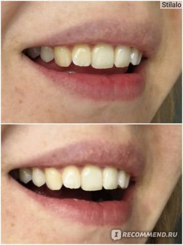Отбеливание зубов при кариесе — возможно ли это? - энциклопедия ochkov.net
