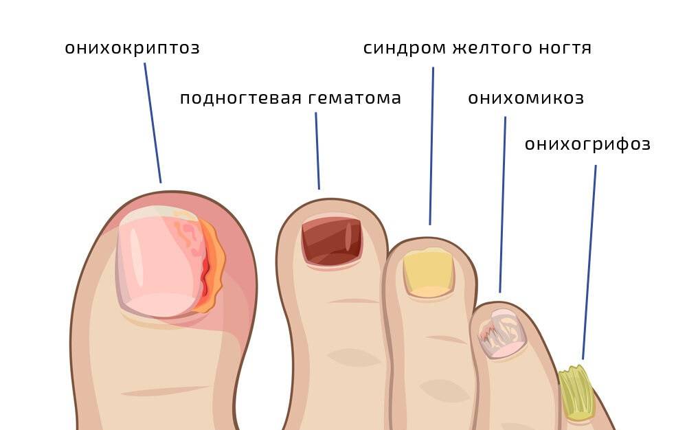 Как лечить грибок ногтей - coolaser clinic