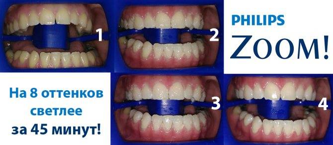 Отбеливание зубов zoom: цена, фото до и после | "мистодентал space"