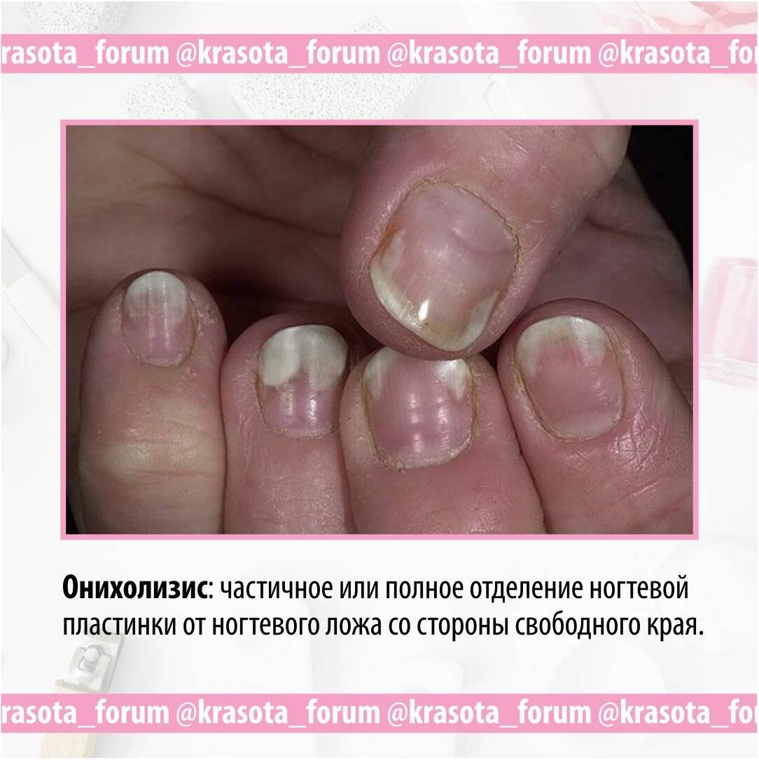 Онихомикоз – заболевание ногтей - медцентр "диагност"