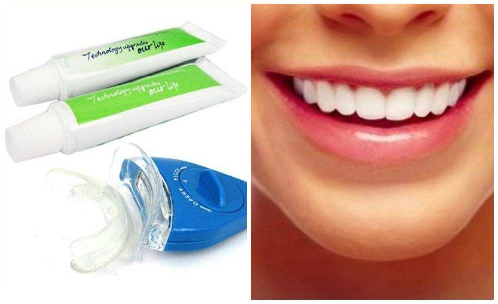 Внутриканальное отбеливание зубов (эндоотбеливание): отзывы, особенности метода