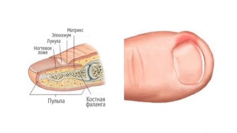 Ушиб ногтя на ноге или руке: что делать, как лечить и надо ли к врачу