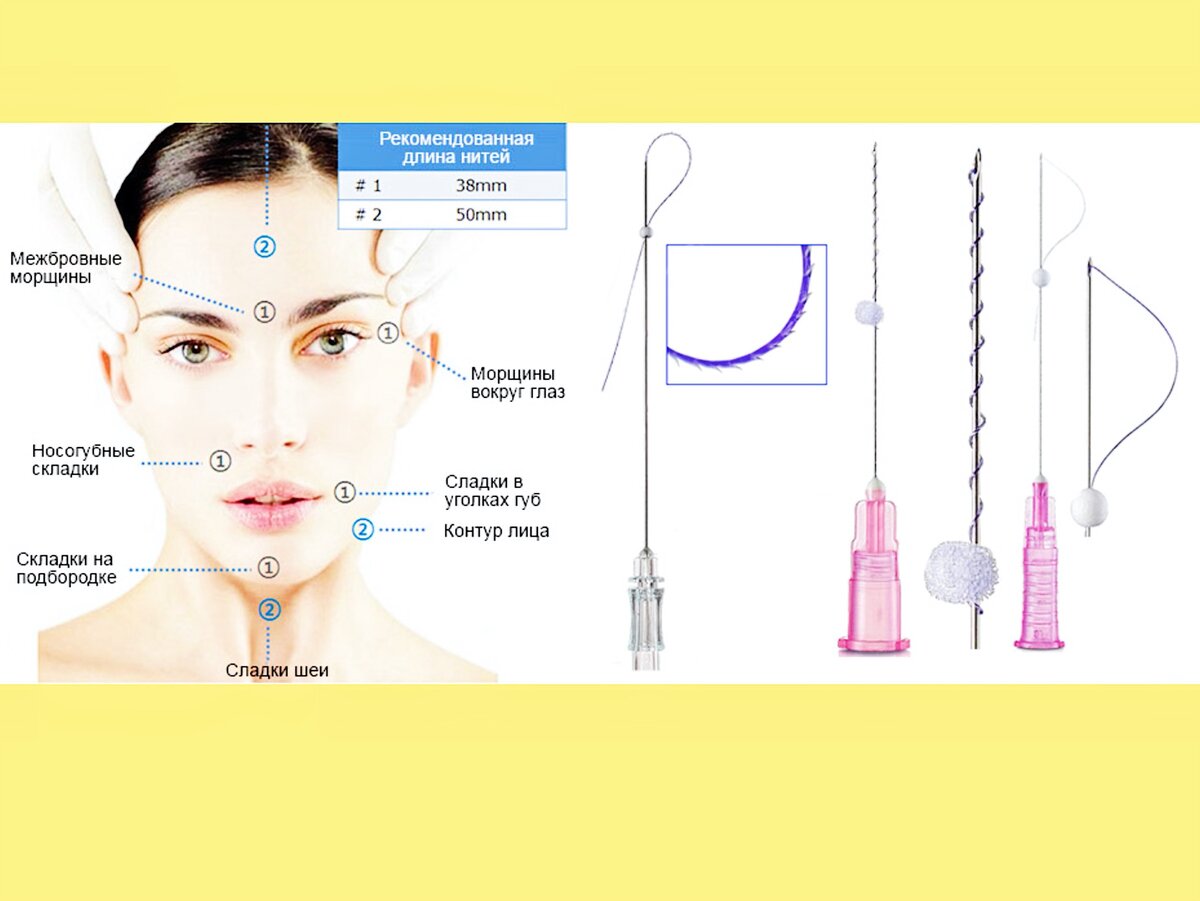 Сколько нитей нужно. Схемы нитевого лифтинга. Схемы введения мезонитей. Мезонити для подтяжки лица схемы. Схема введения нитей в лицо.